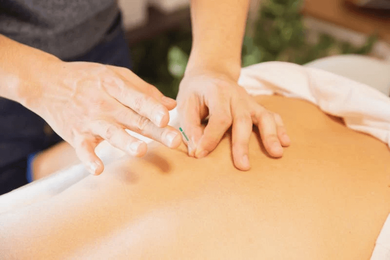 ACUPUNCTURE